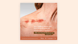 Imagen de un póster que muestra el pecho de una mujer con una representación gráfica evidente de picor en la piel.