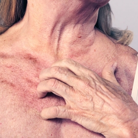 Primer plano de una mujer rascándose la parte superior del pecho, visiblemente incómoda.